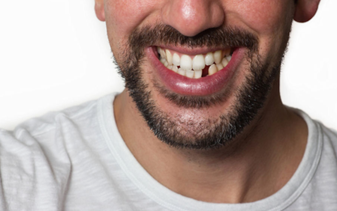 Knocked-Out Tooth? Here’s What You Need to Do Immediately