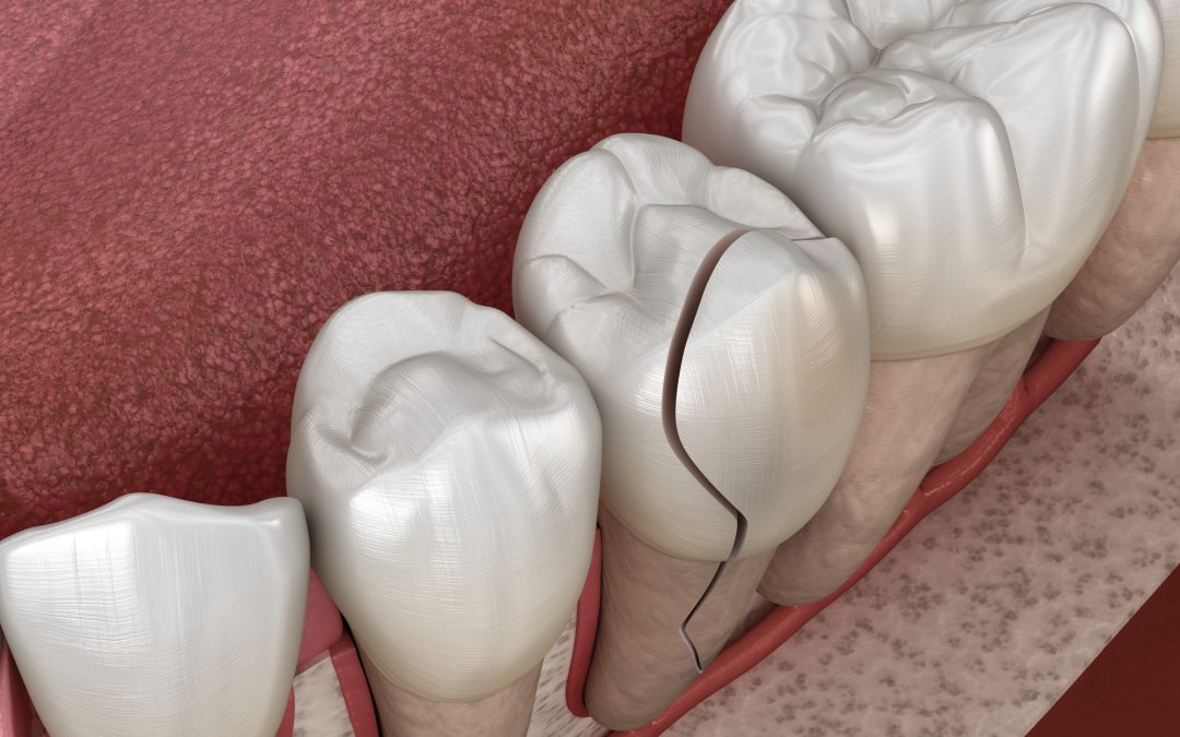 What to Do If You Crack a Tooth: Essential First Aid Steps